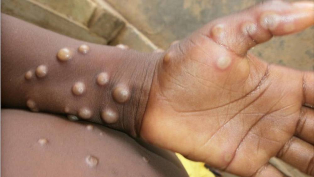 Governo cria grupo e alerta estados sobre varíola dos macacos